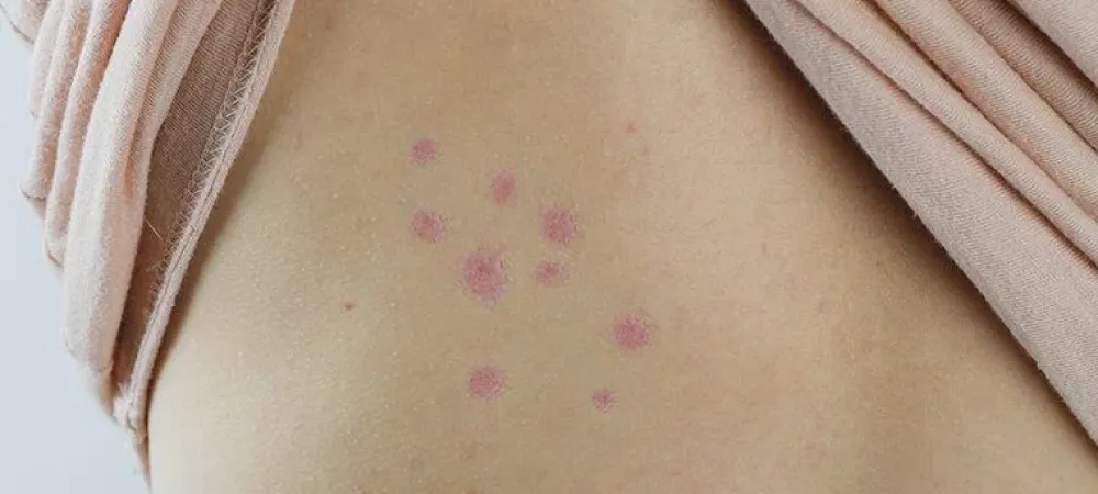 bed bug bites on skin